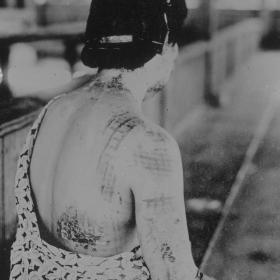 Japanese woman with damaged skin after the atomic bomb.